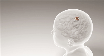 世纪平台：首例脑机接口设备人体移植完成